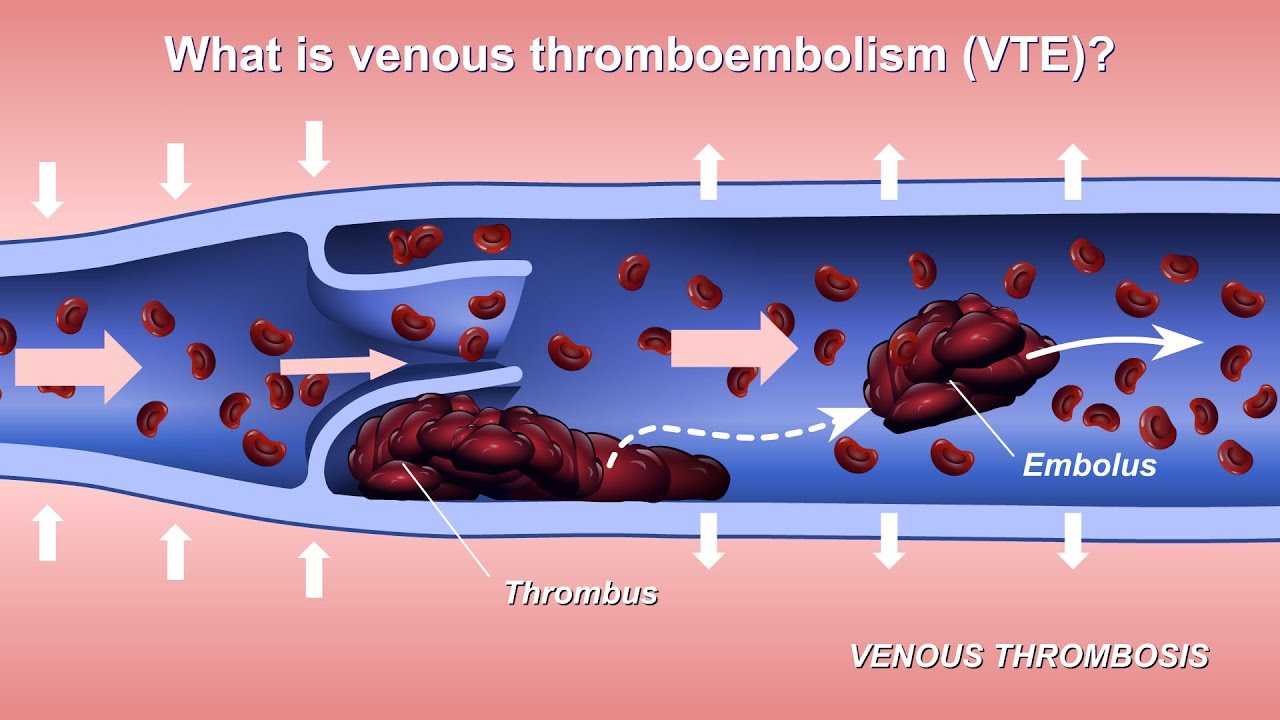 Comparing treatment adherence and Quality of Life in patients with venous thromboembolism on Rivaroxaban versus vitamin K antagonists at Douala General Hospital