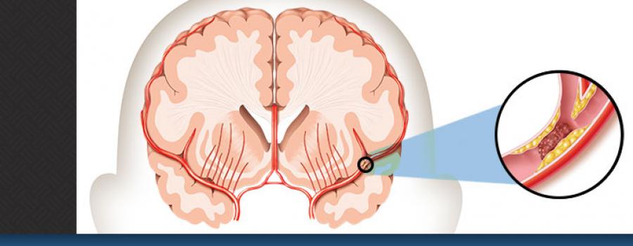 Incidence and factors associated with stroke among patients on maintenance hemodialysis in four hemodialysis centers in Cameroon